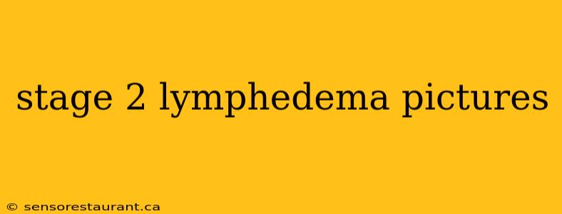 stage 2 lymphedema pictures